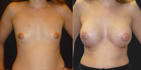 Before and after breast augmentation showing enhanced volume and refined breast contour