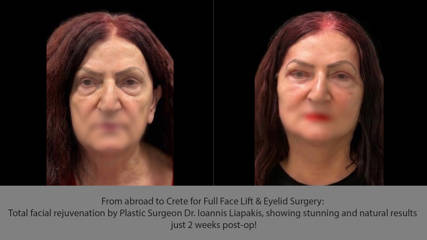 Από το εξωτερικό στην Κρήτη για πλήρες Face Lift και βλεφαροπλαστική: Ολική αναζωογόνηση του προσώπου από τον Πλαστικό Χειρουργό Δρ. Ιωάννη Λιαπάκη, με εντυπωσιακό και φυσικό αποτέλεσμα μόλις 2 εβδομάδες μετά την επέμβαση!