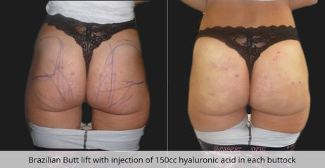 Before and after Brazilian Butt Lift with 150cc hyaluronic acid injections in each buttock, highlighting enhanced volume and shape