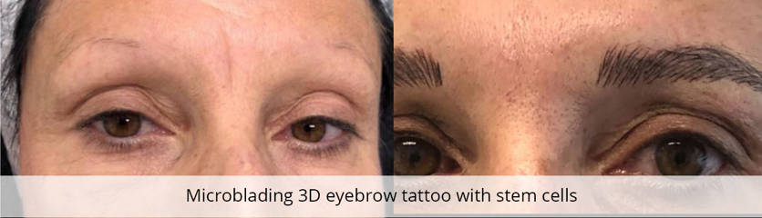 Before and after microblading 3D eyebrow tattoo with stem cells