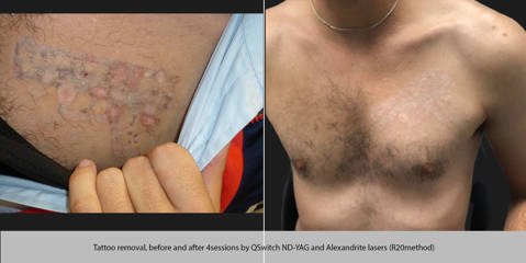 Tattoo removal before and 4 sessions by QSwitch and Alexandrite lasers