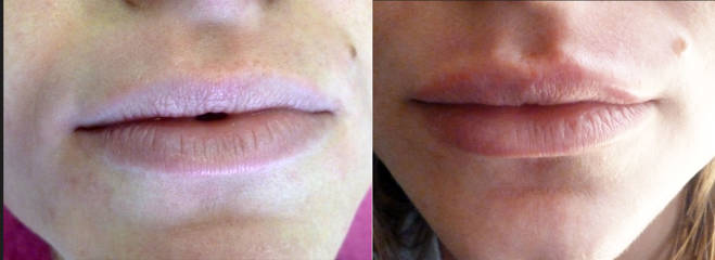Before and after facial implants showing enhanced cheekbone definition and balanced lower-face contour