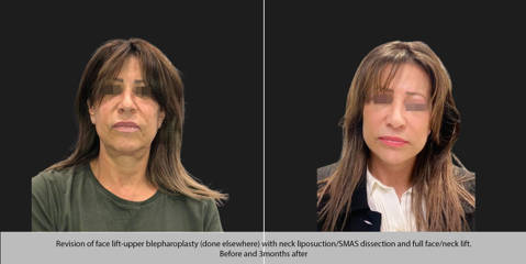 Before and three months after facelift, upper blepharoplasty and neck liposuction