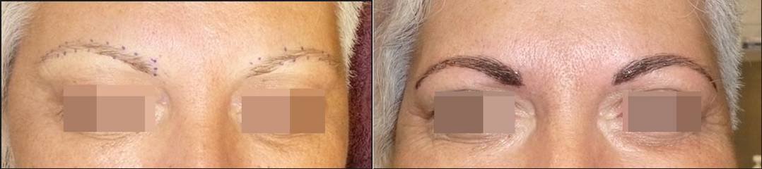 Before and after eyebrow micropigmentation showing new pigment and defined brow shape