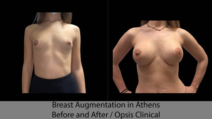 Breast Augmentation in Athens Before and After / Opsis Clinical