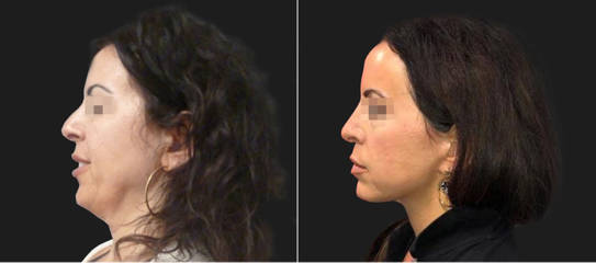 Face Lift41