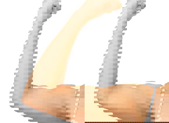 Brachioplasty showing removal of excess skin and refined arm contour