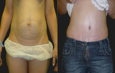 Before and after abdominoplasty showing enhanced waist contour and flatter abdomen