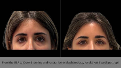 From the USA to Crete: Stunning and natural lower blepharoplasty results just 1 week post-op!