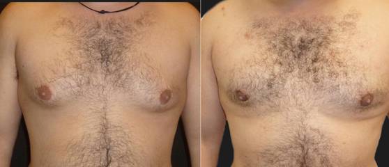 Before and after gynecomastia correction showing reduced gland size and natural male chest contour