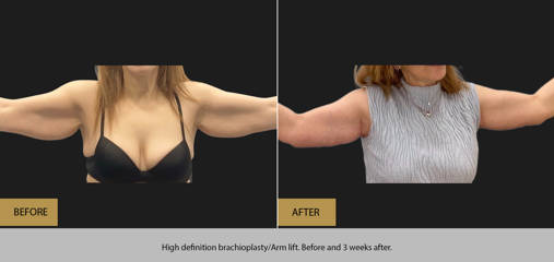 High definition brachioplasty/ arm lift. Before and 3 weeks after