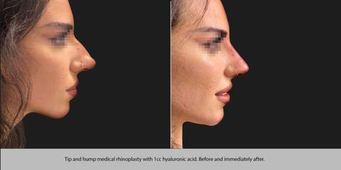 Side profile of young woman before and after non-surgical rhinoplasty using 1cc hyaluronic acid to smooth the nasal hump