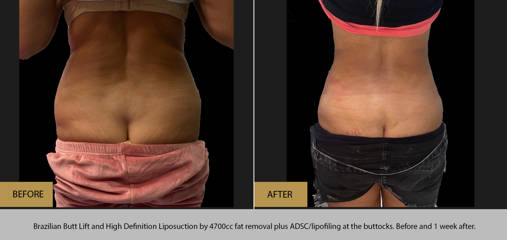 Brazilian butt lift and high definition liposuction by 4700cc fat removal, before and 1 week after