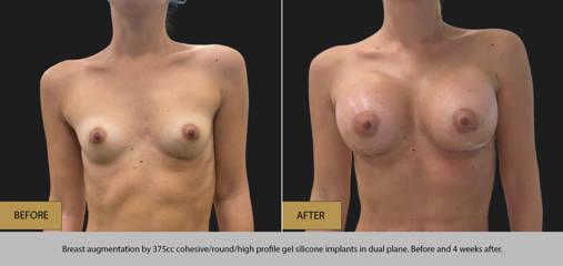 Breast augmentation by 375cc gel silicone implants in dual plane, before and 4 weeks after