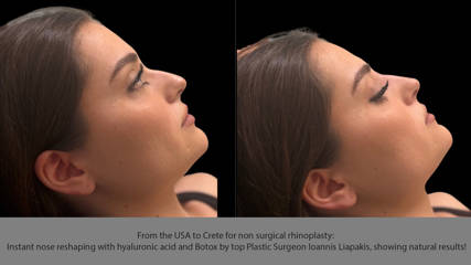 From the USA to Crete for non surgical rhinoplasty: Instant nose reshaping with hyaluronic acid and Botox by top Plastic Surgeon Ioannis Liapakis, showing natural results!