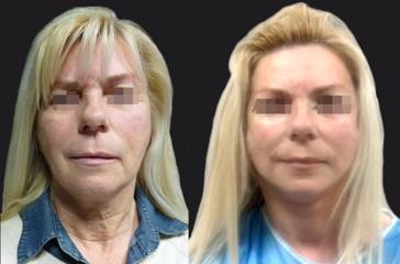 Before and after facelift showing smoother jawline, refined neck contour and refreshed overall facial appearance