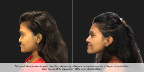Female profile before and 4 weeks after rhinoplasty with dorsal hump reduction and tip projection using columellar strut