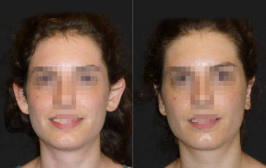 Before and after otoplasty showing correction of protruding ears and restored symmetrical ear position