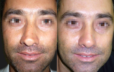 Frontal before and after male patient following rhinoplasty, improved nasal symmetry and refined tip