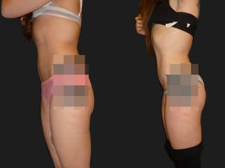 Before and after liposuction comparison of a woman's side profile showing slimmer waistline and smoother body contour
