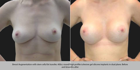 Breast augmentation with stem cells, fat transfer and 400cc silicone implants in dual plane before and 6 months after