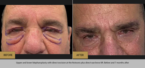 Upper and lower blepharoplasty with direct festoon excision and brow lift, before and 7 months after surgery