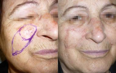 Before and after photos of skin cancer removal and facial reconstruction on the left cheek, showing successful healing