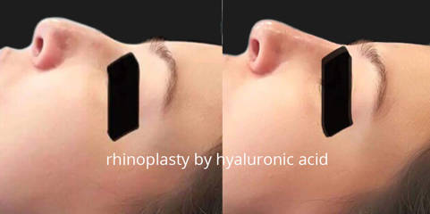 Frofile view before and after non-surgical rhinoplasty using hyaluronic acid