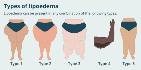 Types Of Lipoedema 29604C