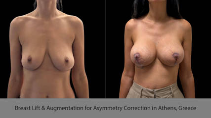Breast Lift & Augmentation for Asymmetry Correction in Athens, Greece