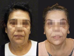 Before and after facelift showing tighter jawline and smoother neck contour in side-profile