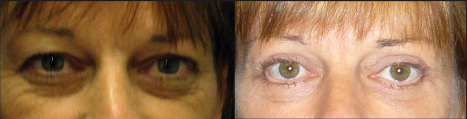 Lower blepharoplasty before and after, showing reduction of under-eye bags and smoother lower eyelid contour