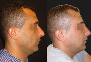 Male patient profile before and after rhinoplasty showing nasal bridge and smoother nose contour