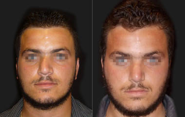 Frontal view before and after rhinoplasty on male patient, showing improved nasal symmetry and refined bridge