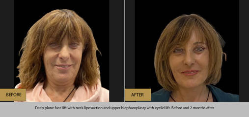 Before and two months after deep plane face lift with neck liposuction and upper blepharoplasty