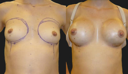 Before and after breast augmentation showing increased volume and improved symmetry with silicone implants