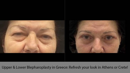 Upper & Lower Blepharoplasty in Greece: Refresh your look in Athens or Crete!