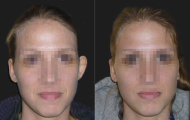 Before and after otoplasty correction asymmetry in one protruding ear for balanced appearance