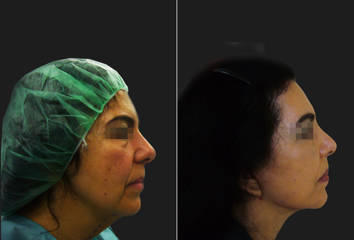 Side view before and after mid facelift showing elevated cheeks and smoother facial contours