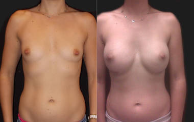 Before and after breast augmentation showing enhanced volume and refined contour