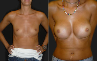 Before and after breast augmentation with silicone implants showing natural contour and enhanced volume