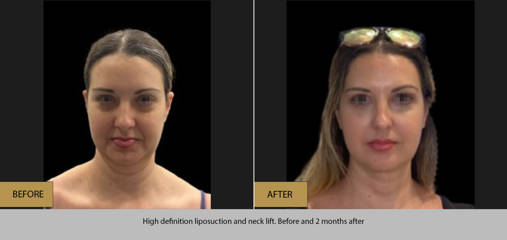 before and after high definition liposuction and neck lift on a woman, showing reduced fullness and enhanced jaw