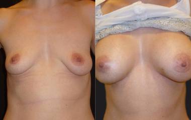 Before and after breast augmentation with silicone implants showing restored volume and improved shape