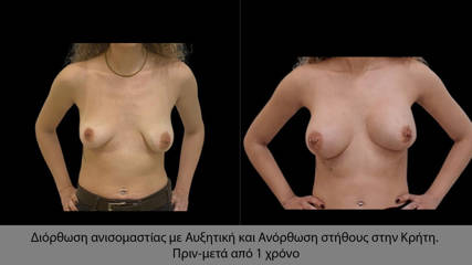 Correction of breast asymmetry with augmentation and lift in Crete. Before-after 1 year