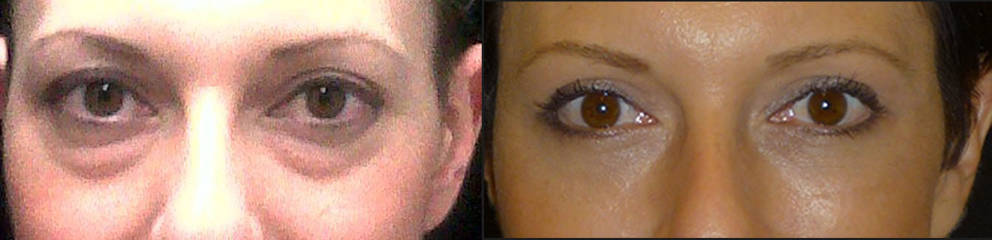 Before and after lower blepharoplasty showing removal of under-eye bags and smoother skin texture for a refreshed appearance