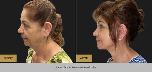 Before and 4 weeks after scarless face lift