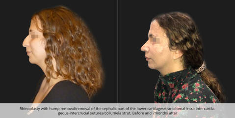 Female profile before and after rhinoplasty with dorsal hump removal and cartilage restructuring, 7 month post-op result