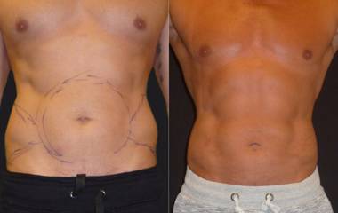Before and after male abdominal liposuction showing defined abs and improved body contour