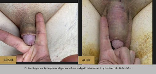 Before and after penis enlargement using suspensory ligament release and fat/stem cell transfer for girth enhancement