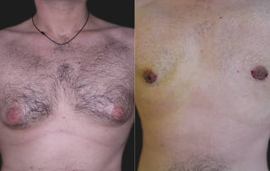 Before and after gynecomastia removal showing reduced glandular tissue and improved chest definition